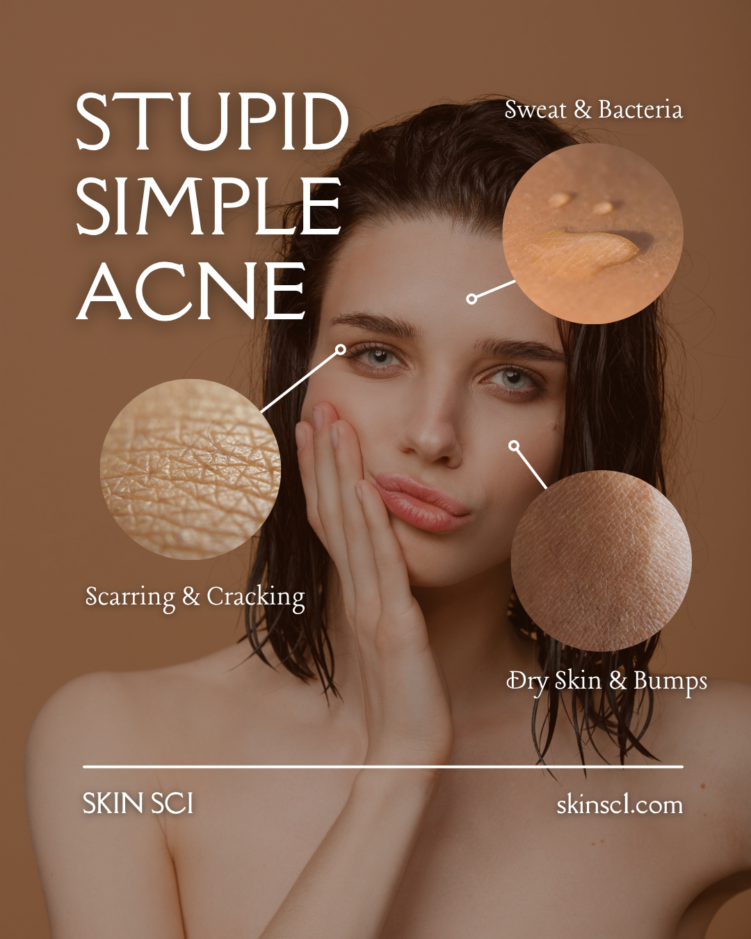 Stupid Simple Acne Protocol